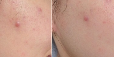 Kem chấm mụn Jean D'Arcel Blemish Control 30ml - Giảm sưng, xẹp mụn nhanh chóng, sản phẩm chăm sóc da mụn hiệu quả từ Đức