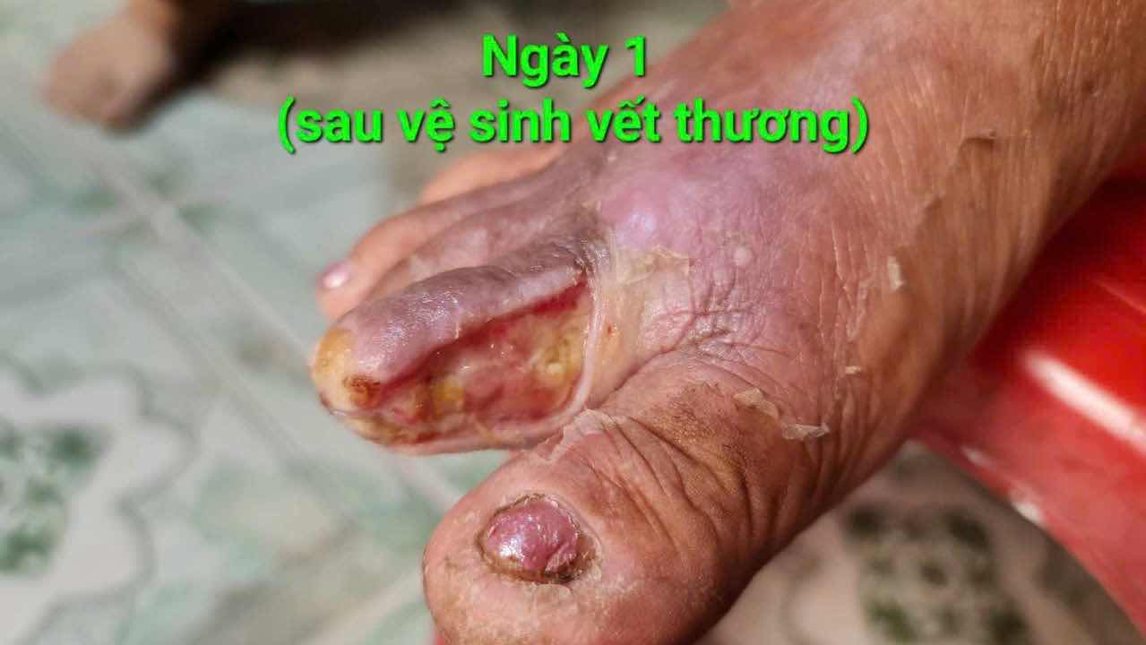 Dung Dịch Vết Thương Hedar - Giảm Đau, Cầm Máu Nhanh, Hỗ Trợ Lành Vết Thương, Phù Hợp Cho Cả Trẻ Nhỏ, Sản Phẩm Y Tế Độc Đáo