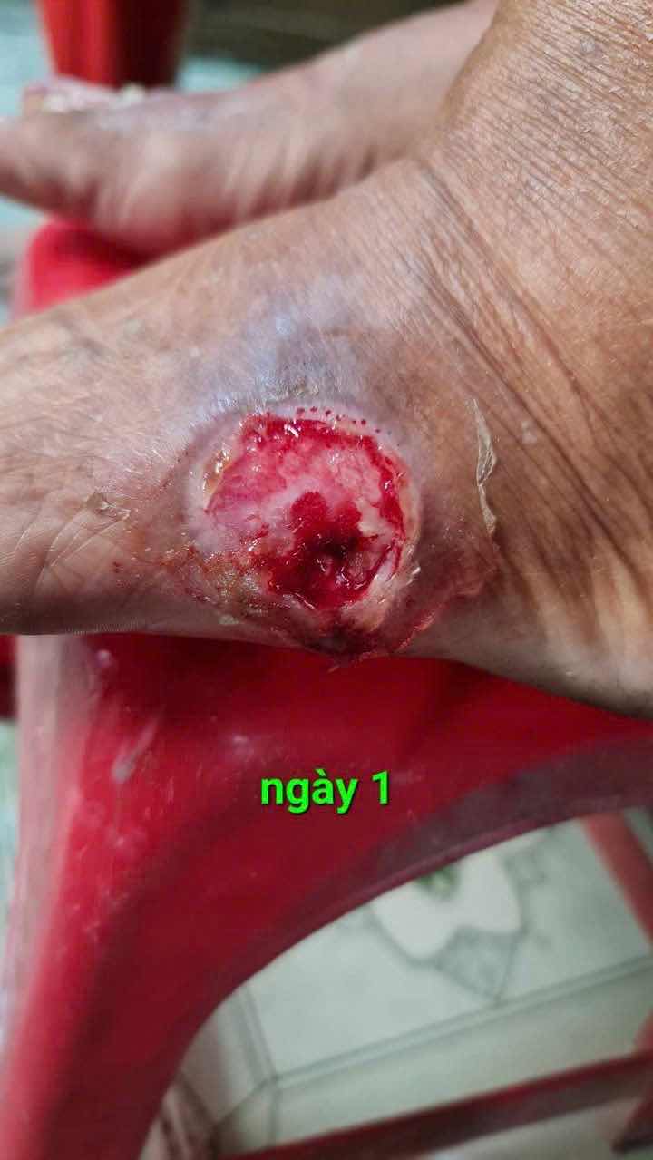 Dung Dịch Vết Thương Hedar - Giảm Đau, Cầm Máu Nhanh, Hỗ Trợ Lành Vết Thương, Phù Hợp Cho Cả Trẻ Nhỏ, Sản Phẩm Y Tế Độc Đáo