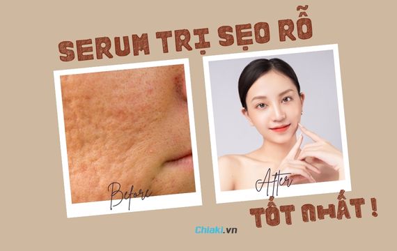 Những bí quyết sử dụng serum trị mụn thâm sẹo rỗ 