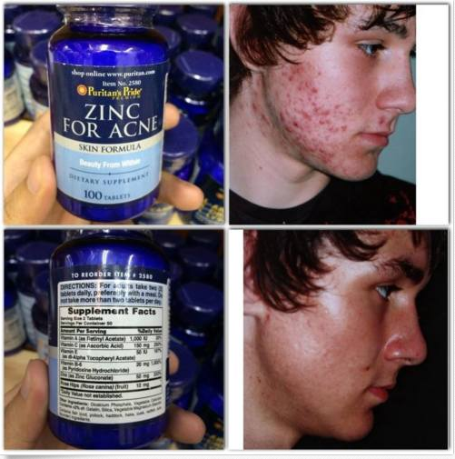 Trước và sau khi sử dụng viên kẽm trị mụn Zinc for Acne Puritant’s Pride 