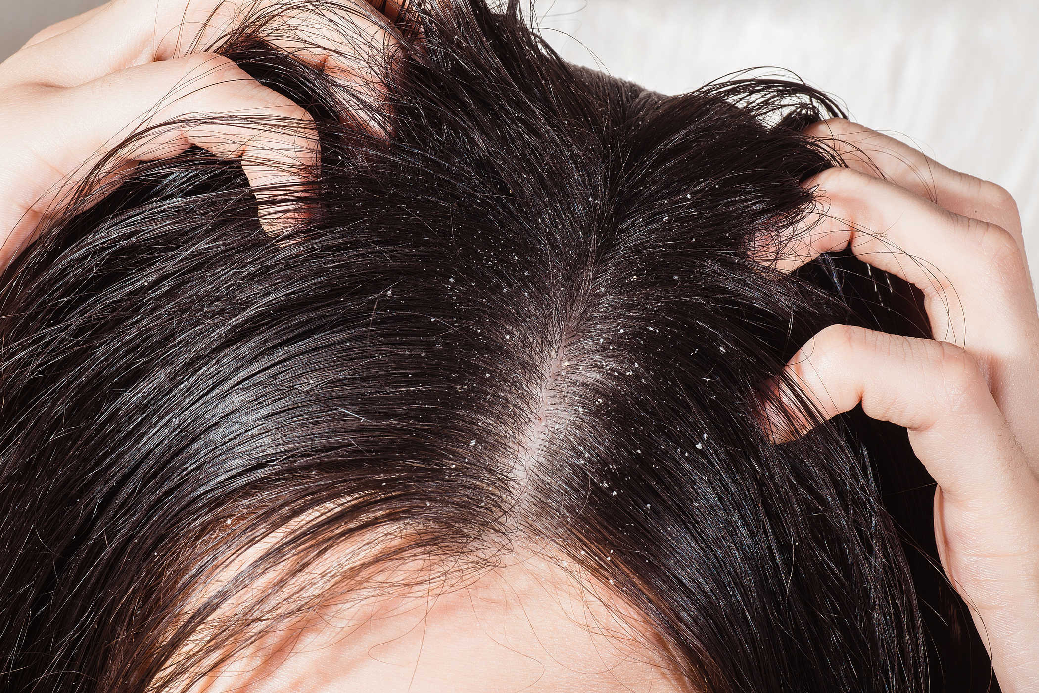 Dầu gội trị gàu Himalaya Anti-dandruff shampoo có tác dụng làm sạch gàu, ngăn ngừa quá trình tái hình thành gàu 