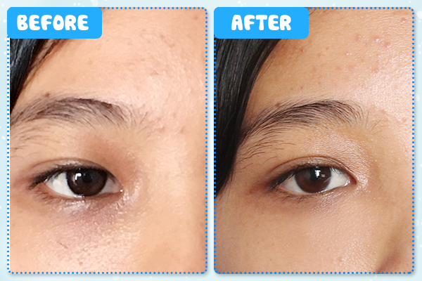 Trước và sau khi sử dụng Kem Trị Thâm Quầng Mắt White Label Premium Placenta Eye Cream