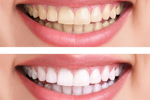 Kem đánh răng Median Dental Iq 93% chăm sóc răng hiệu quả