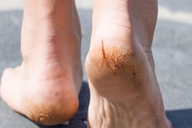 Nứt gót chân bắt nguồn từ nhiều nguyên nhân 