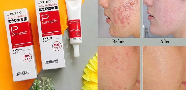 Kem trị mụn Shiseido Pimplit giúp giảm mụn viêm đỏ, giảm tắc lỗ chân lông