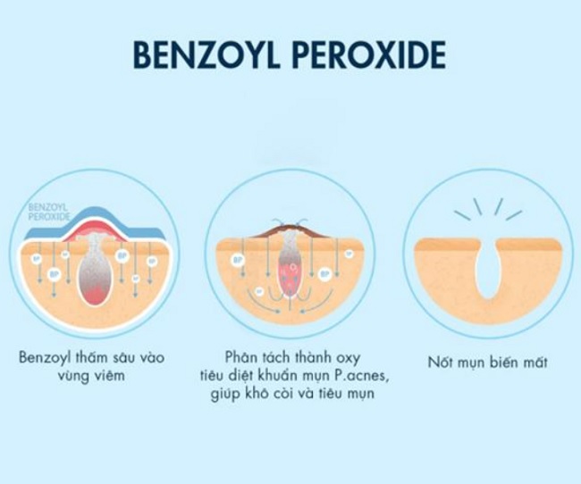 Benzoyl peroxide là gì?