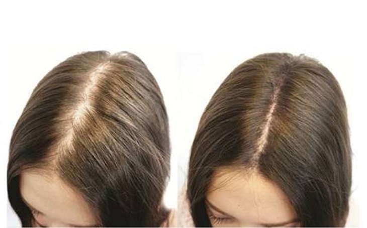 Viên uống hỗ trợ giảm rụng tóc Martiderm Hair System Anti Hair thay đổi khác biệt cho tóc