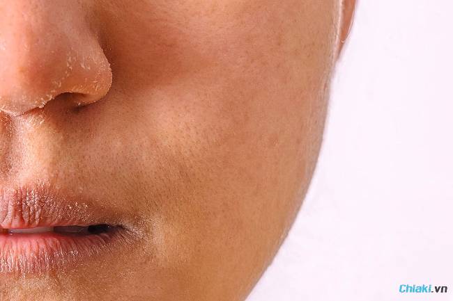 Có nhiều nguyên nhân khiến bạn nên dùng mặt nạ cấp ẩm cho da khô