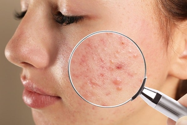Nữ giới xuất hiện tình trạng mụn ẩn nhiều hơn nam giới Nữ giới xuất hiện tình trạng mụn ẩn nhiều hơn nam giới