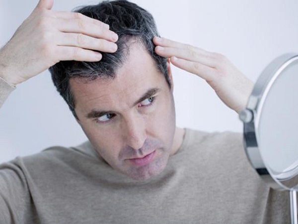 4 Sai lầm thường gặp khi điều trị hói đầu ở nam giới